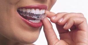 Esimerkkikuva Invisalign-oikomiskalvoista