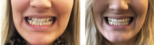 Miian hampaat ennen ja jälkeen Invisalign-oikomishoitoa